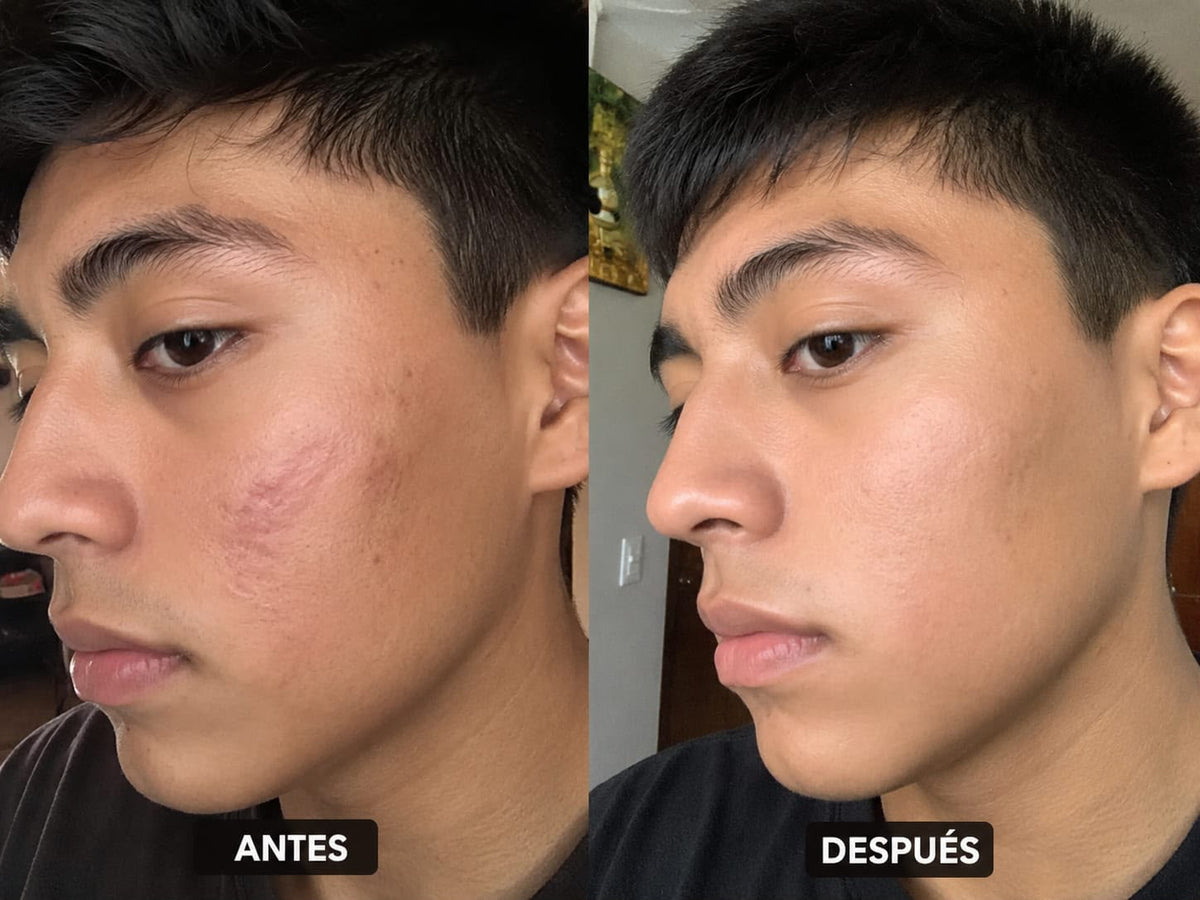 ¡ScarMP¡™ - 😱Elimina tus cicatricez rapidamente😱